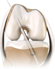 ACL Reconstruction