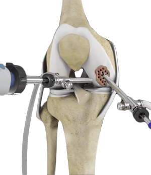 Arthroscopic Debridement