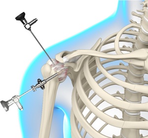 arthroscopic-frozen-shoulder-release