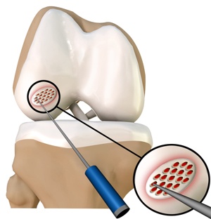 cartilage-microfracture