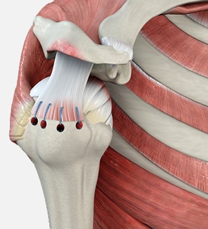 Rotator Cuff Repair