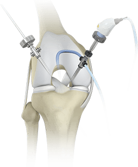 Knee Arthroscopy