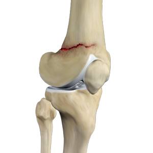 knee-fracture