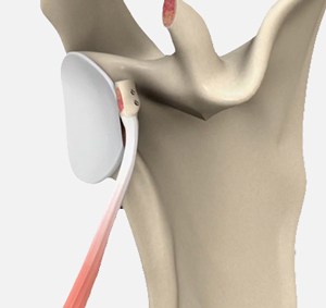 Latarjet Procedure