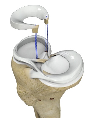 meniscal-transplantation