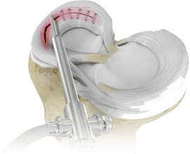 Meniscal Surgery