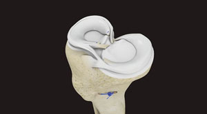 Meniscus Root Repair