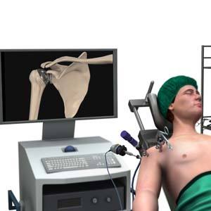 minimally-invasive-shoulder-joint-replacement