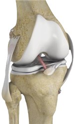 Knee Ligament Reconstruction