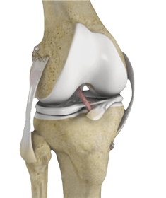 Multiligament Knee Reconstruction