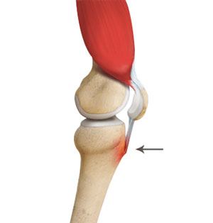 Osgood Schlatter Disease