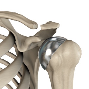partial-shoulder-joint-replacement