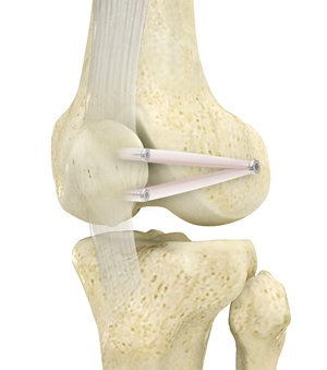 Patellofemoral Stabilisation