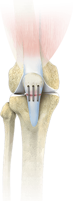 Patellar Tendon Repair