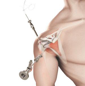 Shoulder Arthroscopy