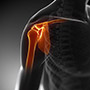 Complex Shoulder Reconstruction