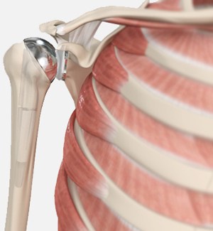 Shoulder Joint Replacement