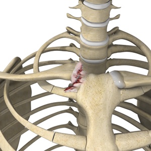 sternoclavicular-joint-reconstruction