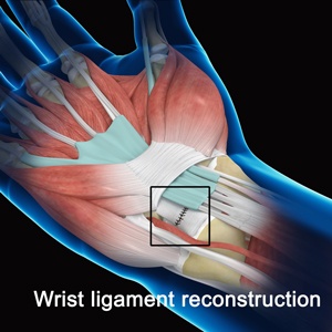 Ligament Reconstruction